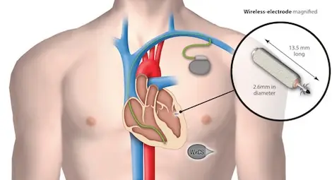 ЕС одобри безжичен мини пейсмейкър 
