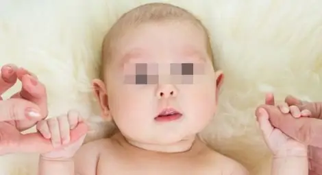 4-месечно бебе оцеля, след като извадиха тумор със зъби от мозъка му 4-месечно бебе оцеля, след като извадиха тумор със зъби от мозъка му