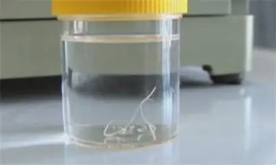 Извадиха 10-сантиметров червей от окото на шивачка с уникална за България операция