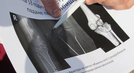 Спасиха раздробено коляно в &bdquo;Канев&ldquo; с неприлаган досега метод в България