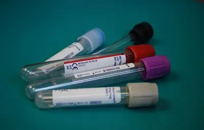 Момиче от ЮАР стана третото дете в света, надвило вируса на СПИН