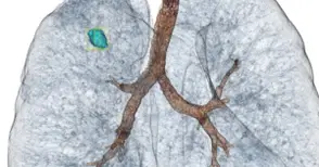 Микроинвазивна процедура с изключителна сложност и висок риск извършена в „Канев“