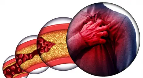 Най-ефективните храни за понижаване на холестерола