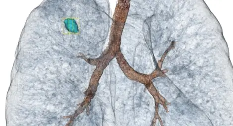 Микроинвазивна процедура с изключителна сложност и висок риск извършена в болница "Канев"