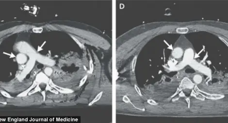 Сърцето на моторист мина вдясно след катастрофа